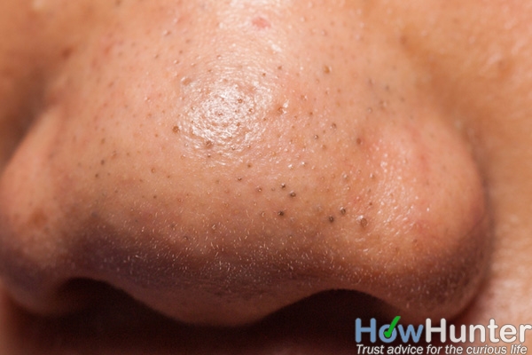 12 tips to get rid of blackheads on nose fast