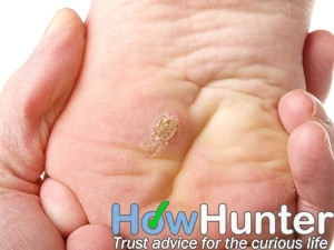 10 ways to get rid of warts fast and naturally