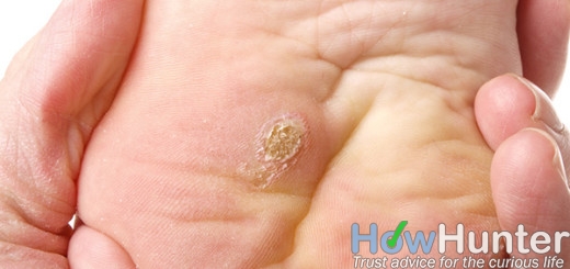 10 ways to get rid of warts fast and naturally