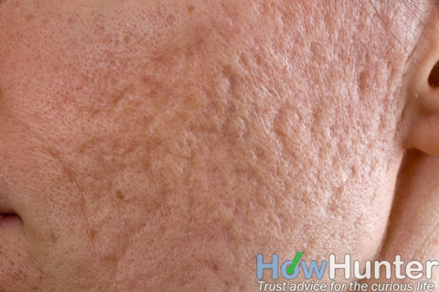 How to Get Rid of Acne Scars Overnight Fast | HowHunter