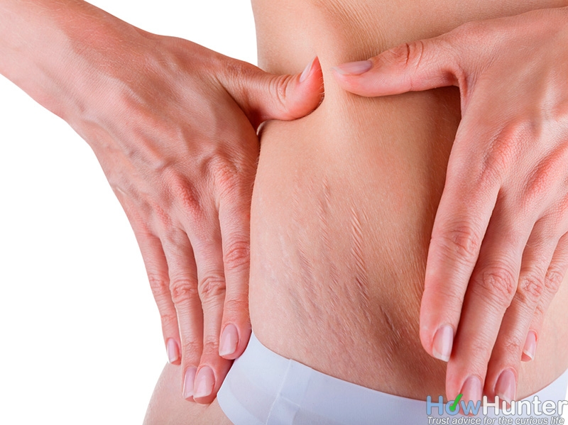 10 Ways To Get Rid Of Stretch Marks Fast and Naturally ...