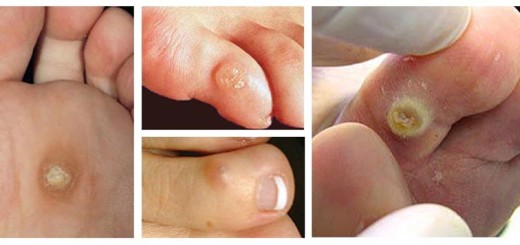 how to get rid of corns on your toes