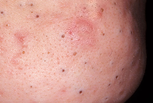 5 Ways To Get Rid Of Deep Blackheads Fast | HowHunter