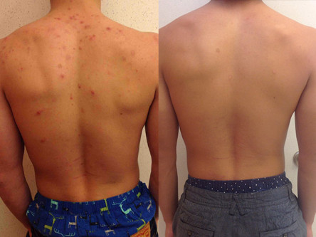 10 Ways to Get Rid Of Back Acne Fast and Naturally | HowHunter