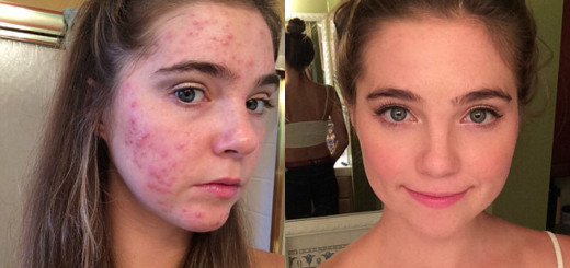 get rid of cystic acne