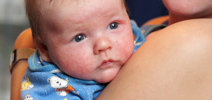 get rid of baby eczema
