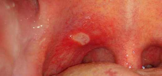 cold sores in mouth pictures
