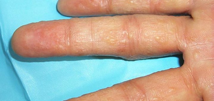 eczema on hands pictures