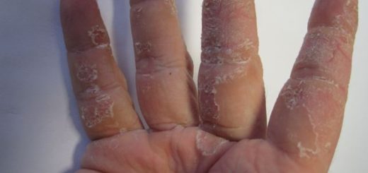 extremely dry skin on hands