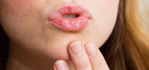 get rid of chapped lips