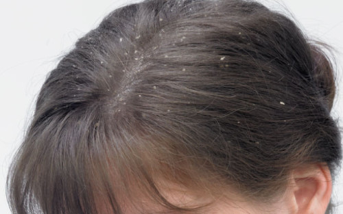 10 Ways To Get Rid Of Dandruff Permanently Fast And