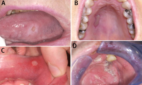 get rid of herpes in mouth