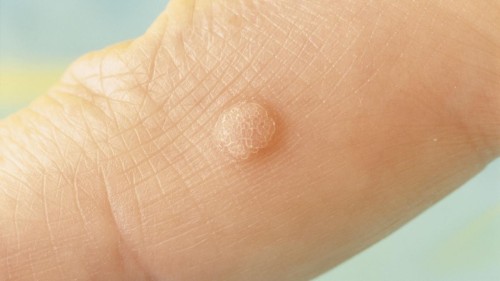 plantar warts pictures