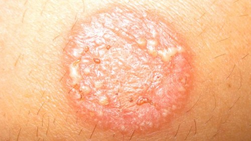how to get rid of ringworm