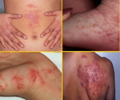 get rid of scabies