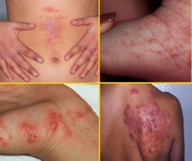 Natural Way To Get Rid Of Scabies 6