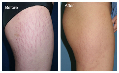 10 Ways to Get Rid of Stretch Marks on Legs Fast | HowHunter