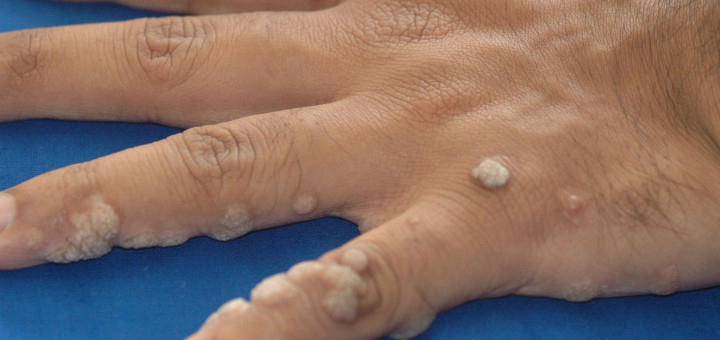 warts on hands pictures