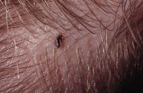 Will rubbing alcohol kill lice?