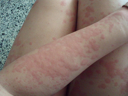 What is heat rash?