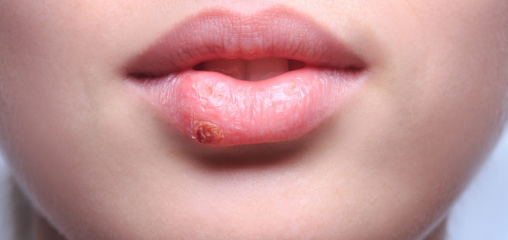get rid of herpes on lip