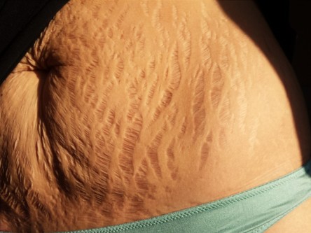 how to get rid of stretch marks after pregnancy