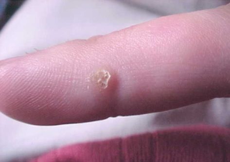 warts on fingers
