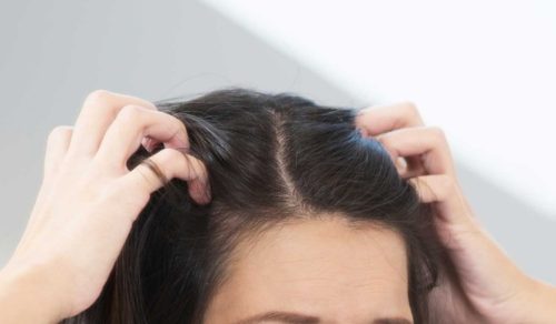 get rid of dry scalp