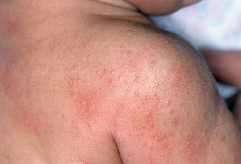 baby rash on body