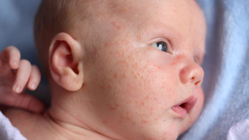 baby rash on face