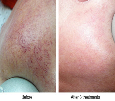 Facial broken capillaries treatment