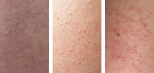 Get Rid Of Bumps On Arms Get Rid Of Bumps