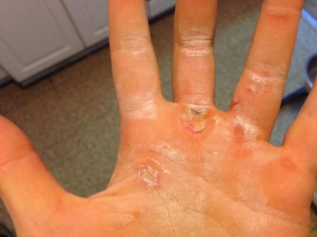 calluses on hands pictures