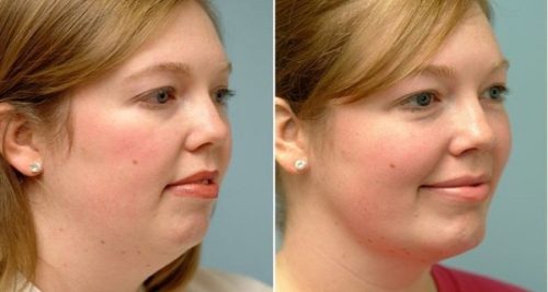 chin fat before and after