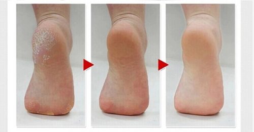 dead skin on feet
