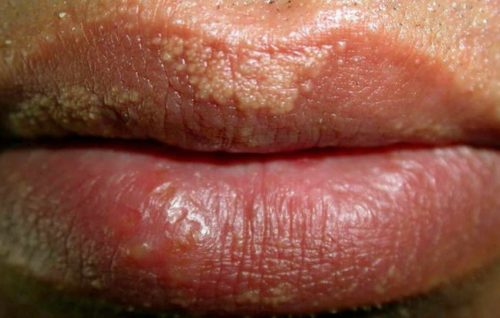 How to Recognize the Signs of Herpes One on the Head of a ...