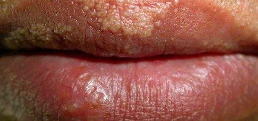 fordyce spots on lips