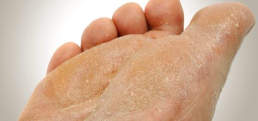 get rid of foot fungus