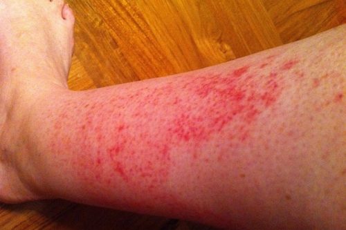 rash on legs