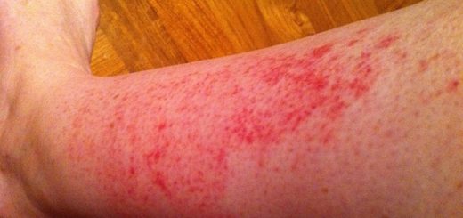rash on legs
