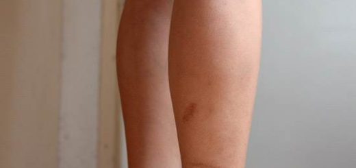get rid of scars on legs