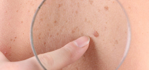 moles on skin