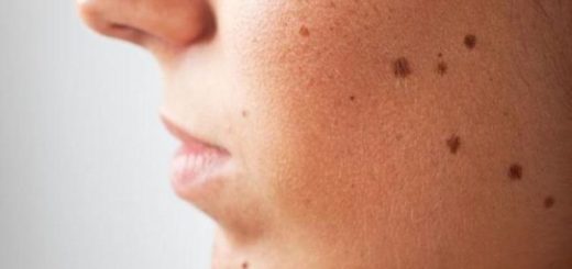 moles on your face