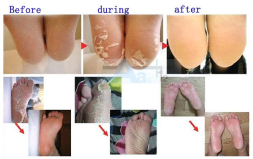 peeling skin on feet