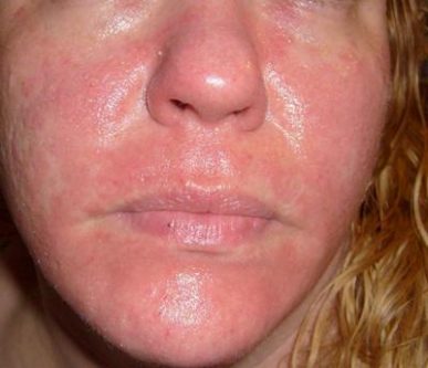 Get Rid Of Facial Rashes 113