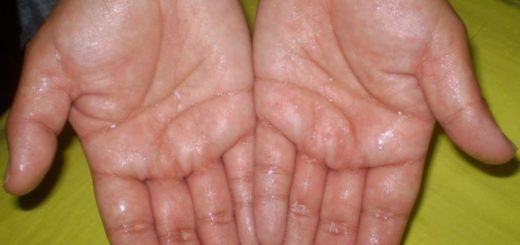 get rid of sweat hands