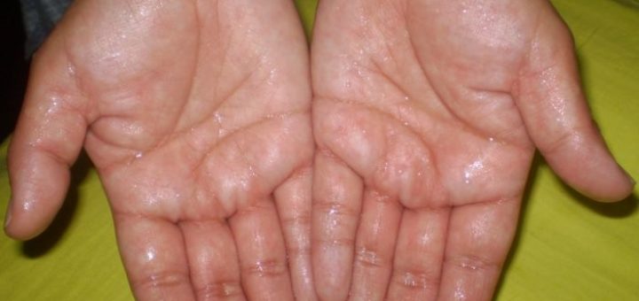 get rid of sweat hands