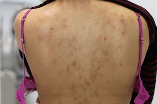 acne scars on back