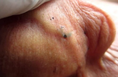 blackheads out of ear