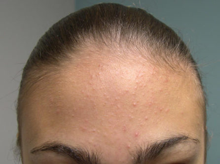 How do you get rid of pimples on your forehead?